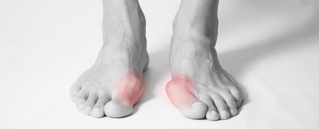 Hallux Valgus (the Diagnosis and Treatment) whitening
