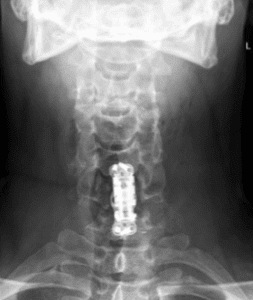 Surgery Dubai Spine Surgery Back Pain Spine Hospital Dubai Spine 