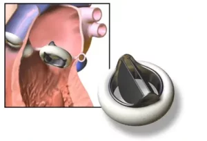 How Heart Valve Replacement Works