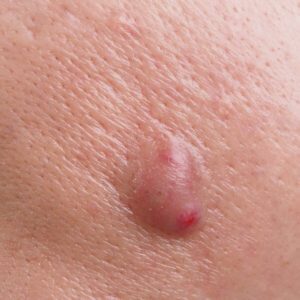 Genital Warts Plantar Warts Human Papillomavirus Laser Treatment Removal In Dubai Called Skin Tags Virus Treat Most Common Types General Anesthesia